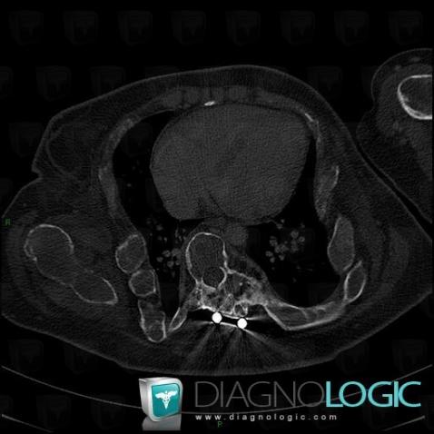 Fibrous dysplasia, Vertebral body / Disk, CT