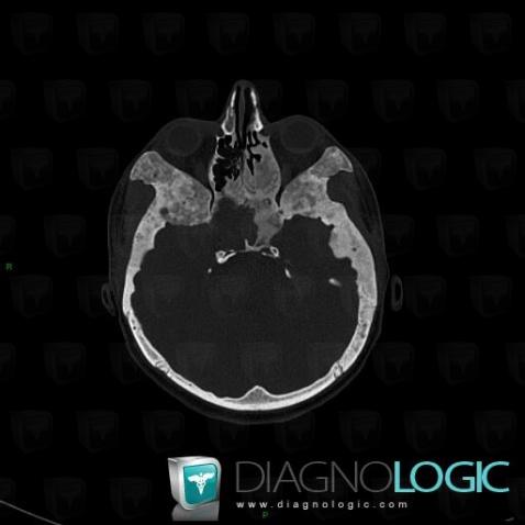 Fibrous dysplasia, Zygomatic / malar bone, CT