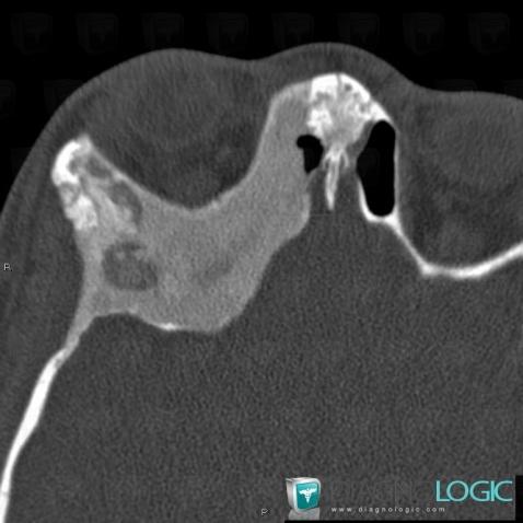 Fibrous dysplasia, Zygomatic / malar bone, Orbital bones, CT