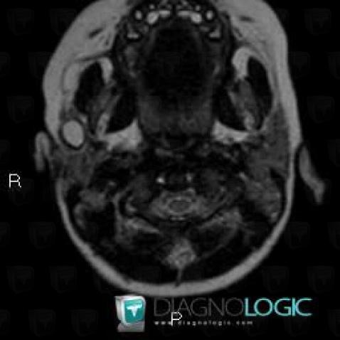 First branchial cleft cyst, Parotid and other salivary glands, MRI