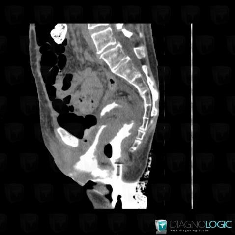 Fistula, Pelvis / Perineum, CT