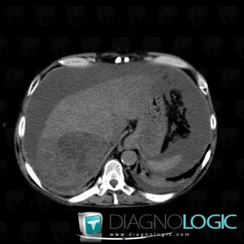 Focal fatty change, Liver, CT