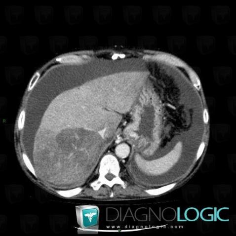 Focal fatty change, Liver, CT