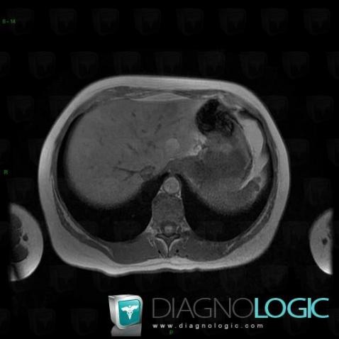 Focal fatty change, Liver, MRI