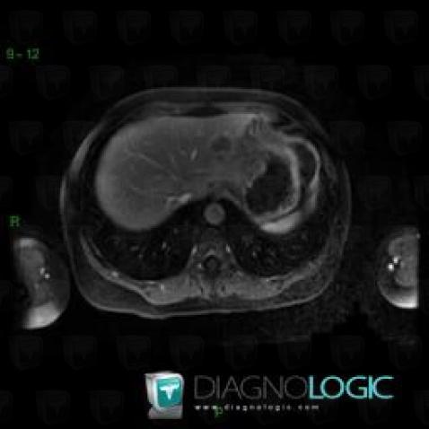 Focal fatty change, Liver, MRI