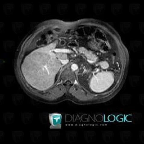 Focal fatty change, Liver, MRI