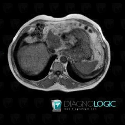 Focal fatty change, Liver, MRI