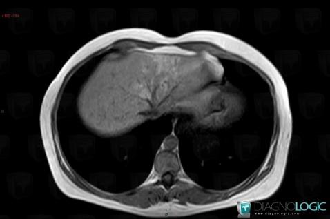 Focal fatty change, Liver, MRI