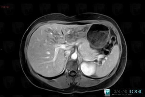 Focal fatty change, Liver, MRI