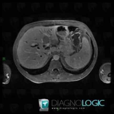 Focal fatty change, Liver, MRI