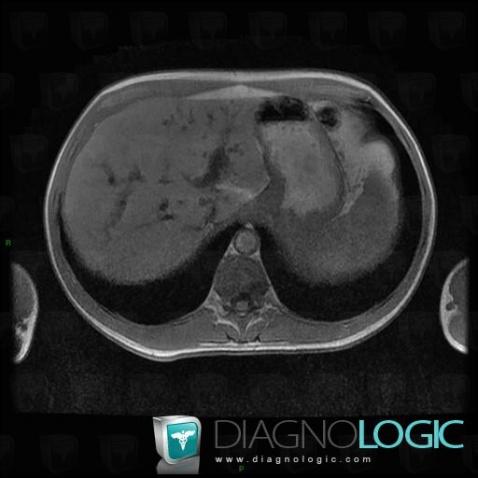 Focal fatty change, Liver, MRI