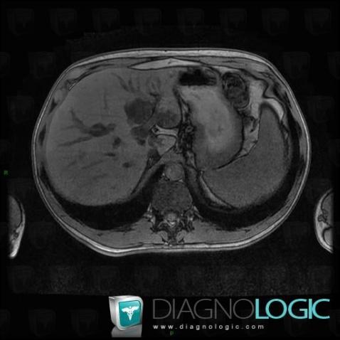 Focal fatty change, Liver, MRI