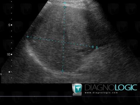 Focal fatty change, Liver, US