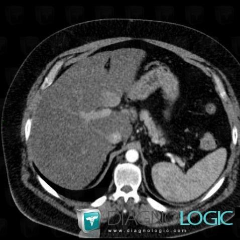 Focal fatty sparing, Liver, CT