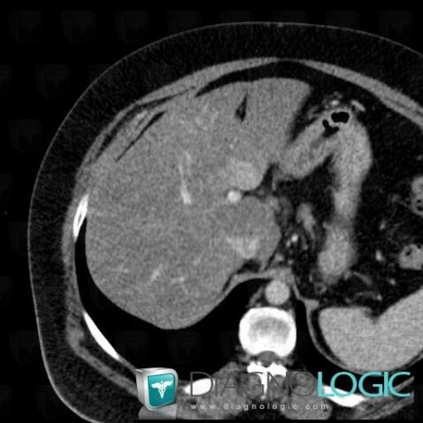 Focal fatty sparing, Liver, CT