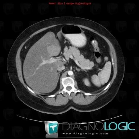 Focal fatty sparing, Liver, CT