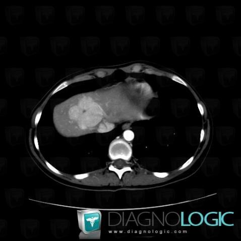 Focal nodular hyperplasia, Liver, CT