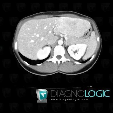 Focal nodular hyperplasia, Liver, CT