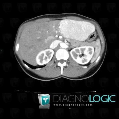 Focal nodular hyperplasia, Liver, CT