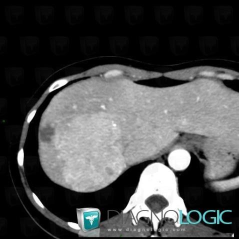 Focal nodular hyperplasia, Liver, CT