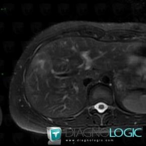 Focal nodular hyperplasia, Liver, MRI