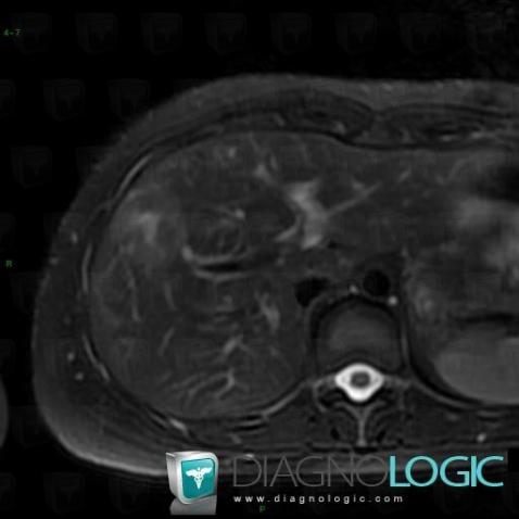 Focal nodular hyperplasia, Liver, MRI