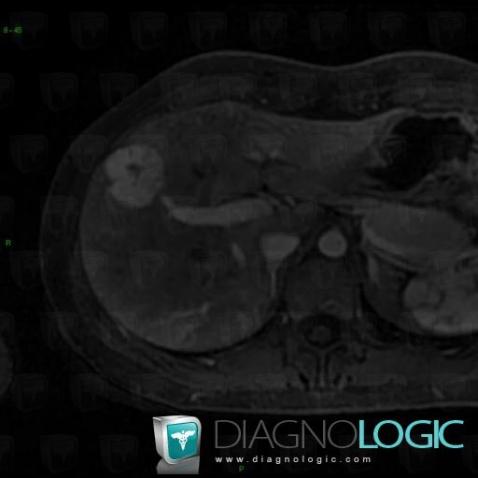 Focal nodular hyperplasia, Liver, MRI
