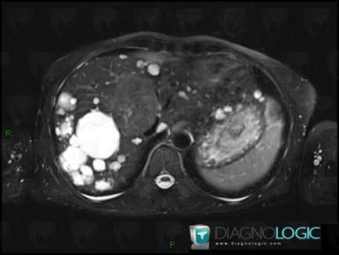 Focal nodular hyperplasia, Liver, MRI