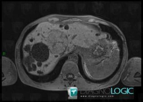 Focal nodular hyperplasia, Liver, MRI