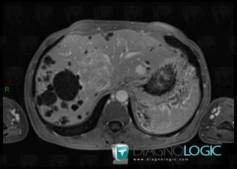 Focal nodular hyperplasia, Liver, MRI