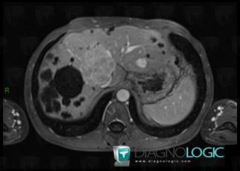 Focal nodular hyperplasia, Liver, MRI