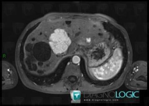 Focal nodular hyperplasia, Liver, MRI