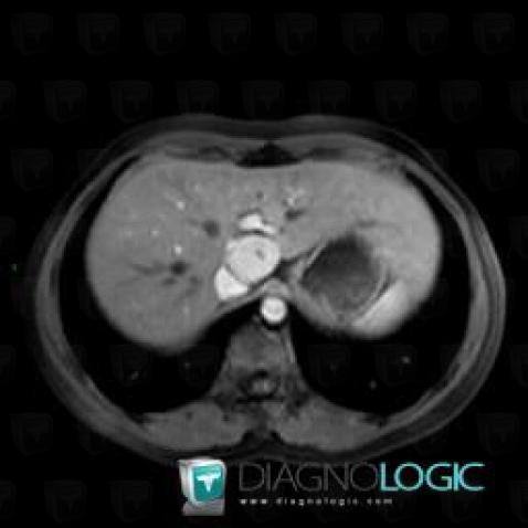 Focal nodular hyperplasia, Liver, MRI