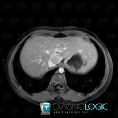 Focal nodular hyperplasia, Liver, MRI