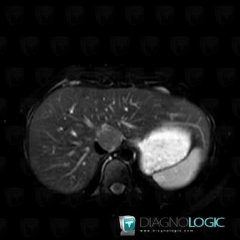 Focal nodular hyperplasia, Liver, MRI