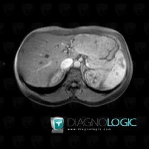 Focal nodular hyperplasia, Liver, MRI