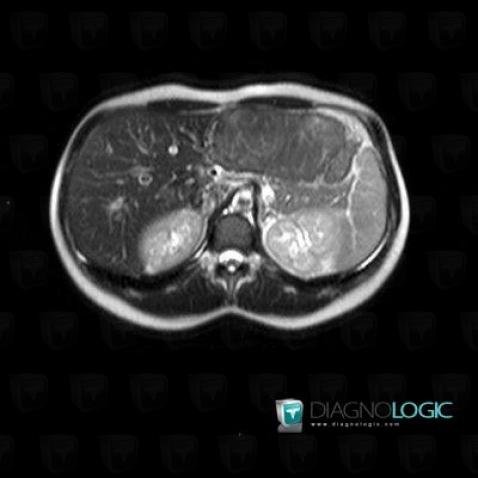 Focal nodular hyperplasia, Liver, MRI