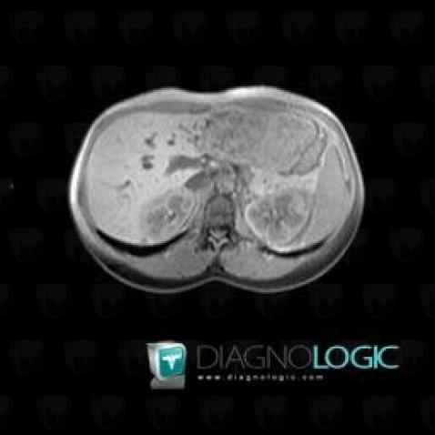 Focal nodular hyperplasia, Liver, MRI