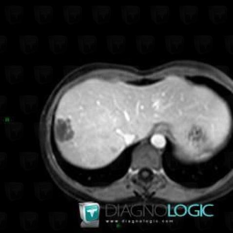 Focal nodular hyperplasia, Liver, MRI