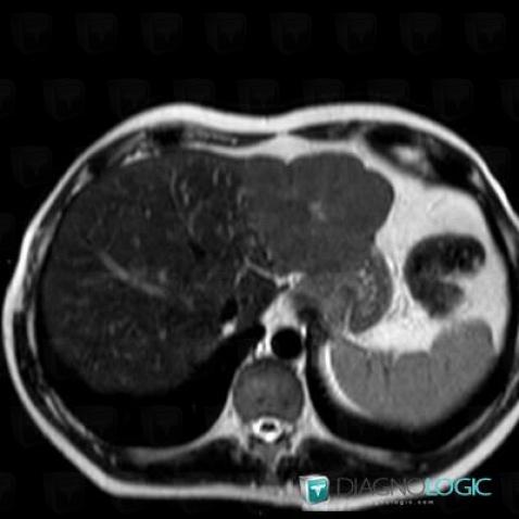 Focal nodular hyperplasia, Liver, MRI