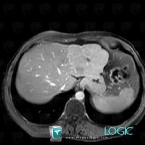 Focal nodular hyperplasia, Liver, MRI