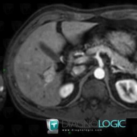 Focal nodular hyperplasia, Liver, MRI