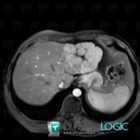 Focal nodular hyperplasia, Liver, MRI