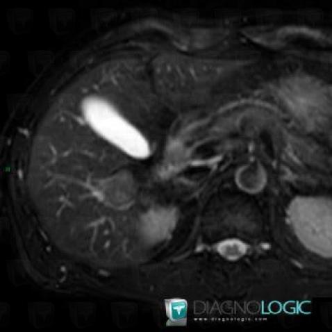 Focal nodular hyperplasia, Liver, MRI