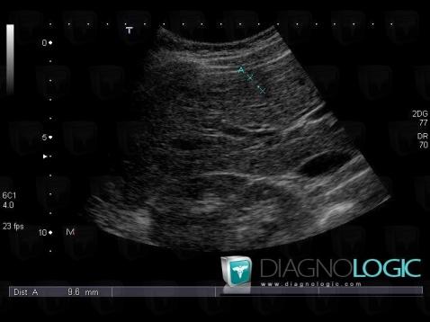 Focal nodular hyperplasia, Liver, US