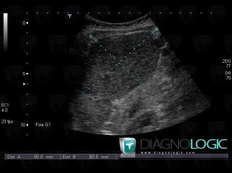 Focal nodular hyperplasia, Liver, US