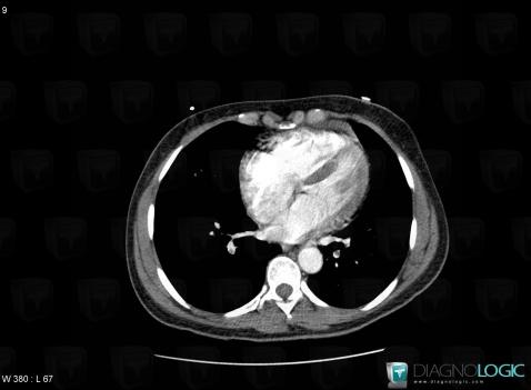 Foramen ovale perméable, Cavités cardiaques / Péricarde, Scanner