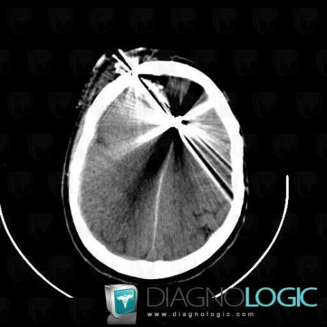 Foreign body, Cerebral hemispheres, CT