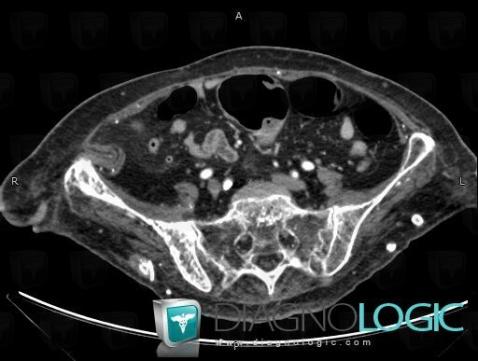 Foreign body granuloma, Other soft tissues/nerves - Pelvis, CT