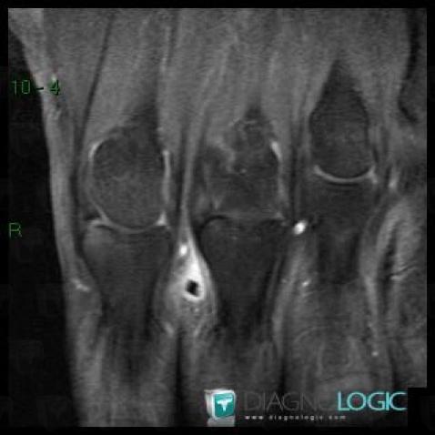 Foreign body, Interphalangeal joint - Hand, MRI